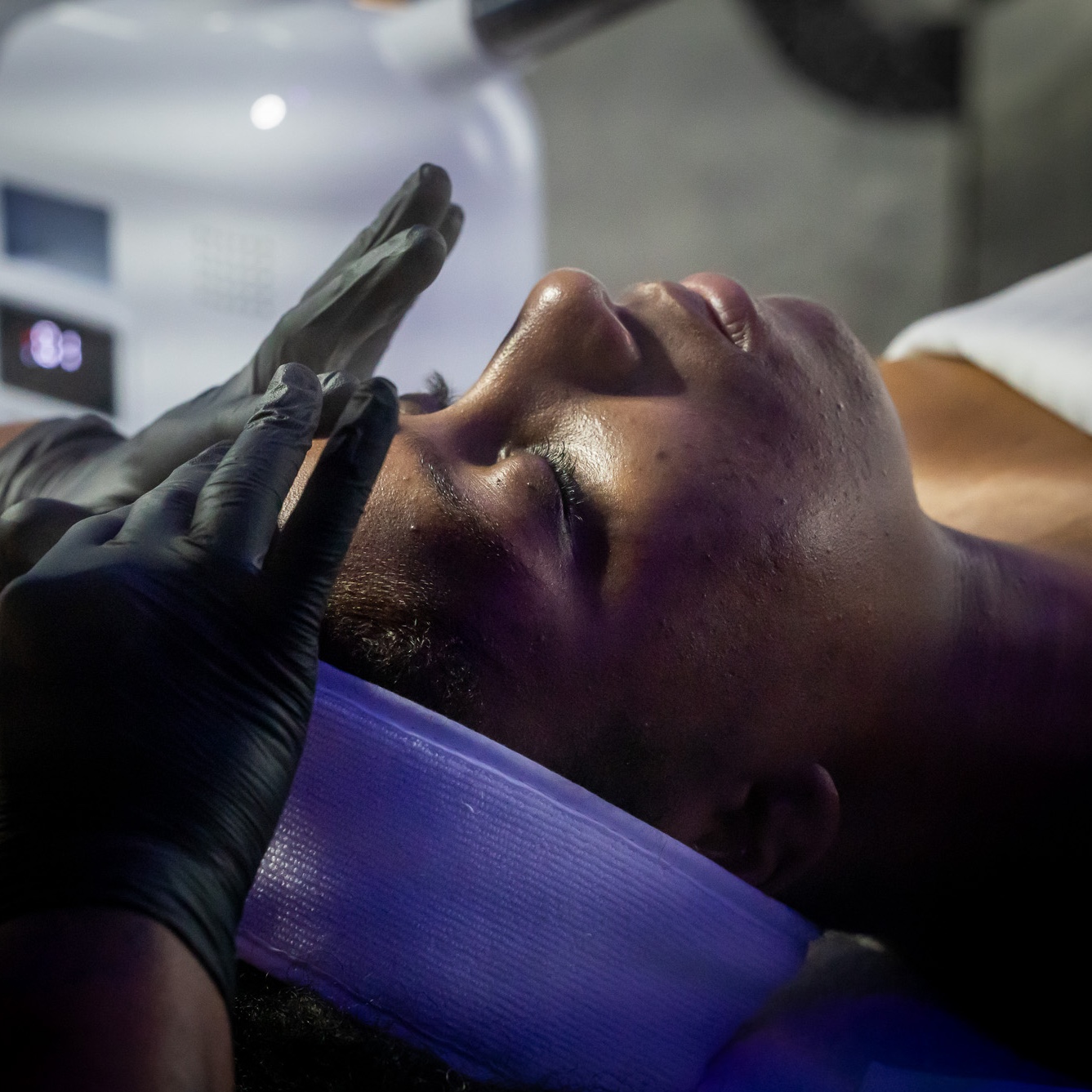 Chemical Peels