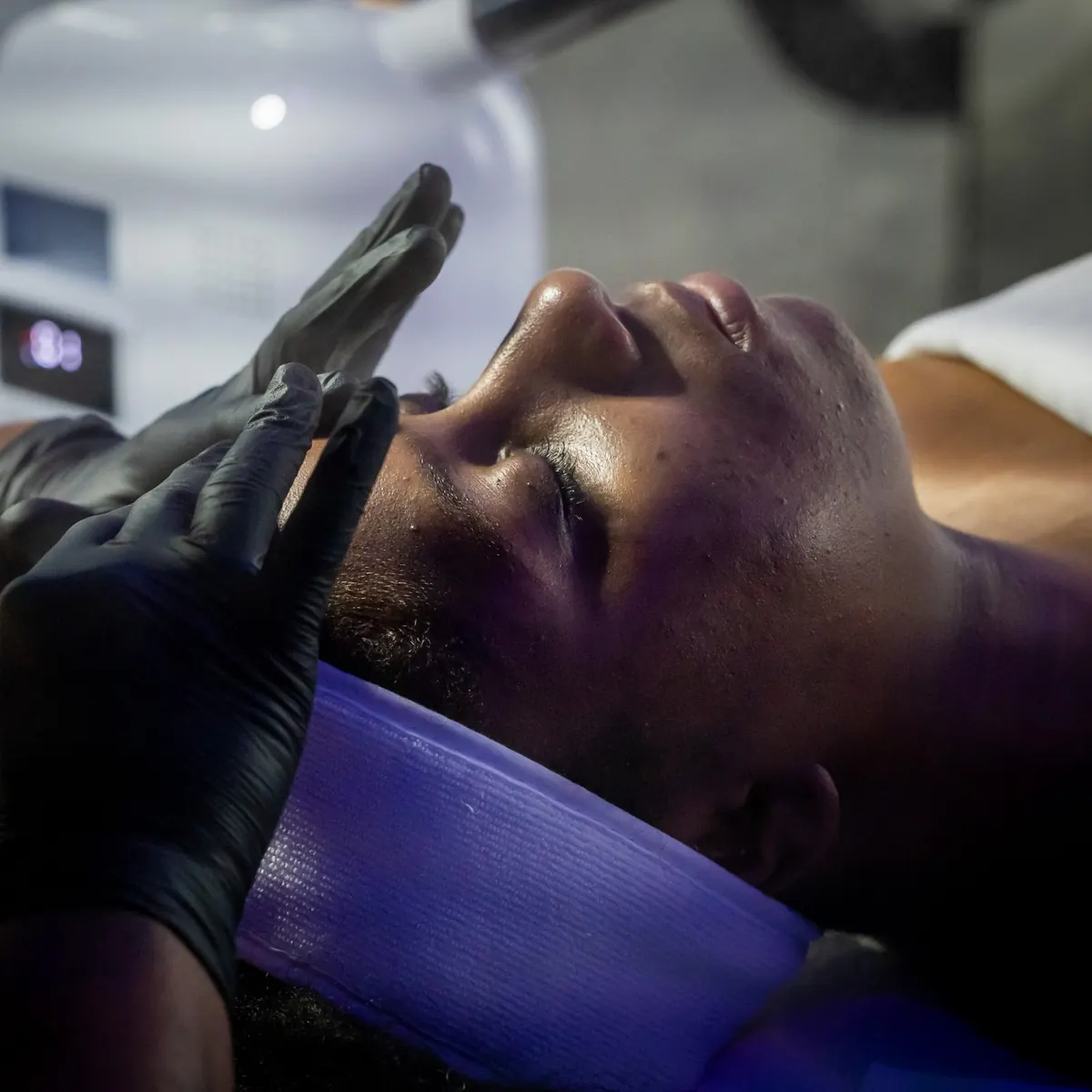 Chemical Peels