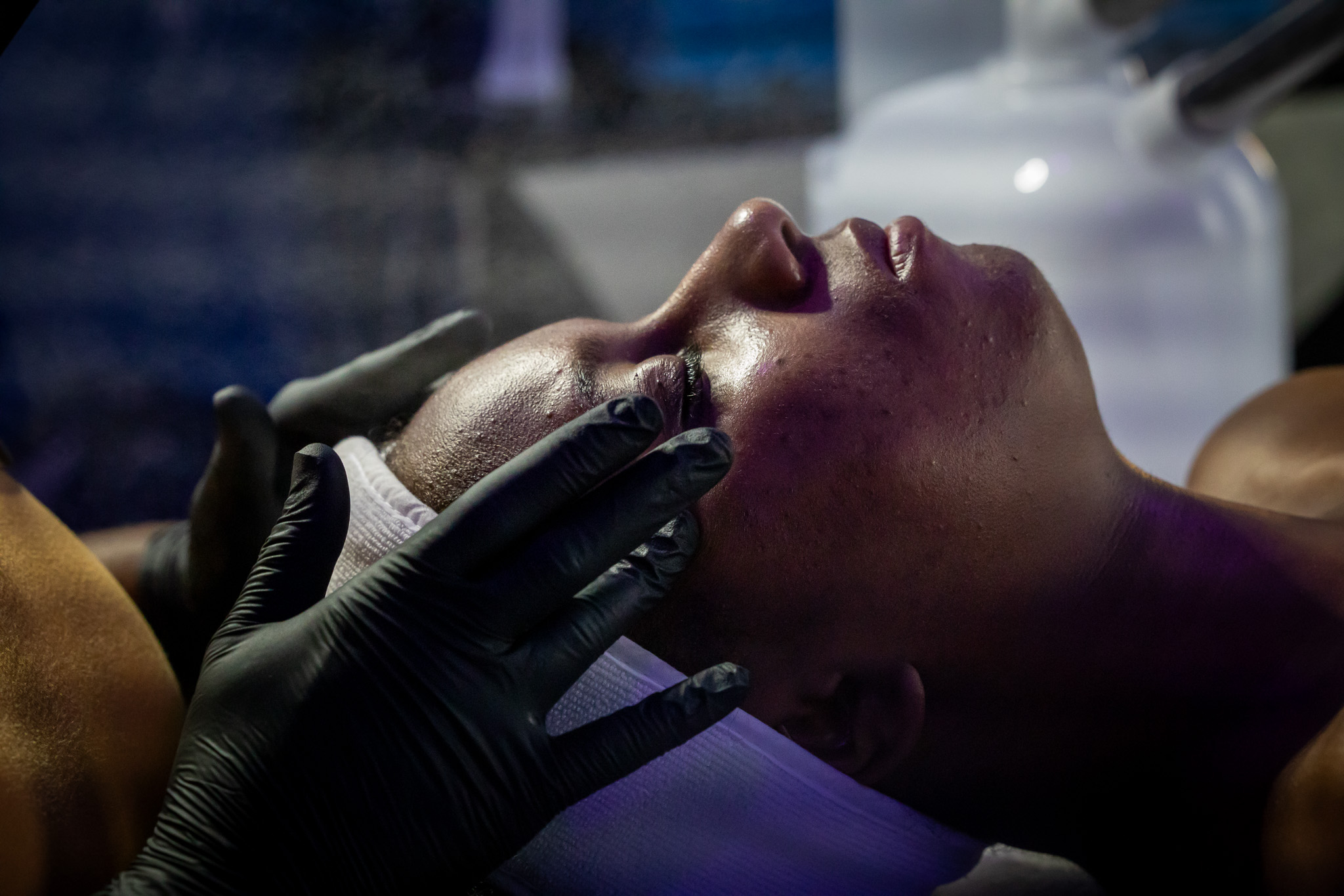 Discover the Benefits of Chemical Peels